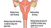 Bệnh buồng trứng đa nang gây vô sinh ở nữ
