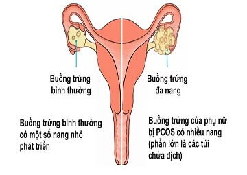 Bệnh buồng trứng đa nang gây vô sinh ở nữ